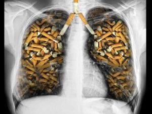 Chủ yếu bệnh ung thư phổi tại Việt Nam là do thuốc lá